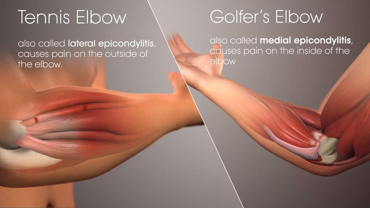 golf-tennis-elbow